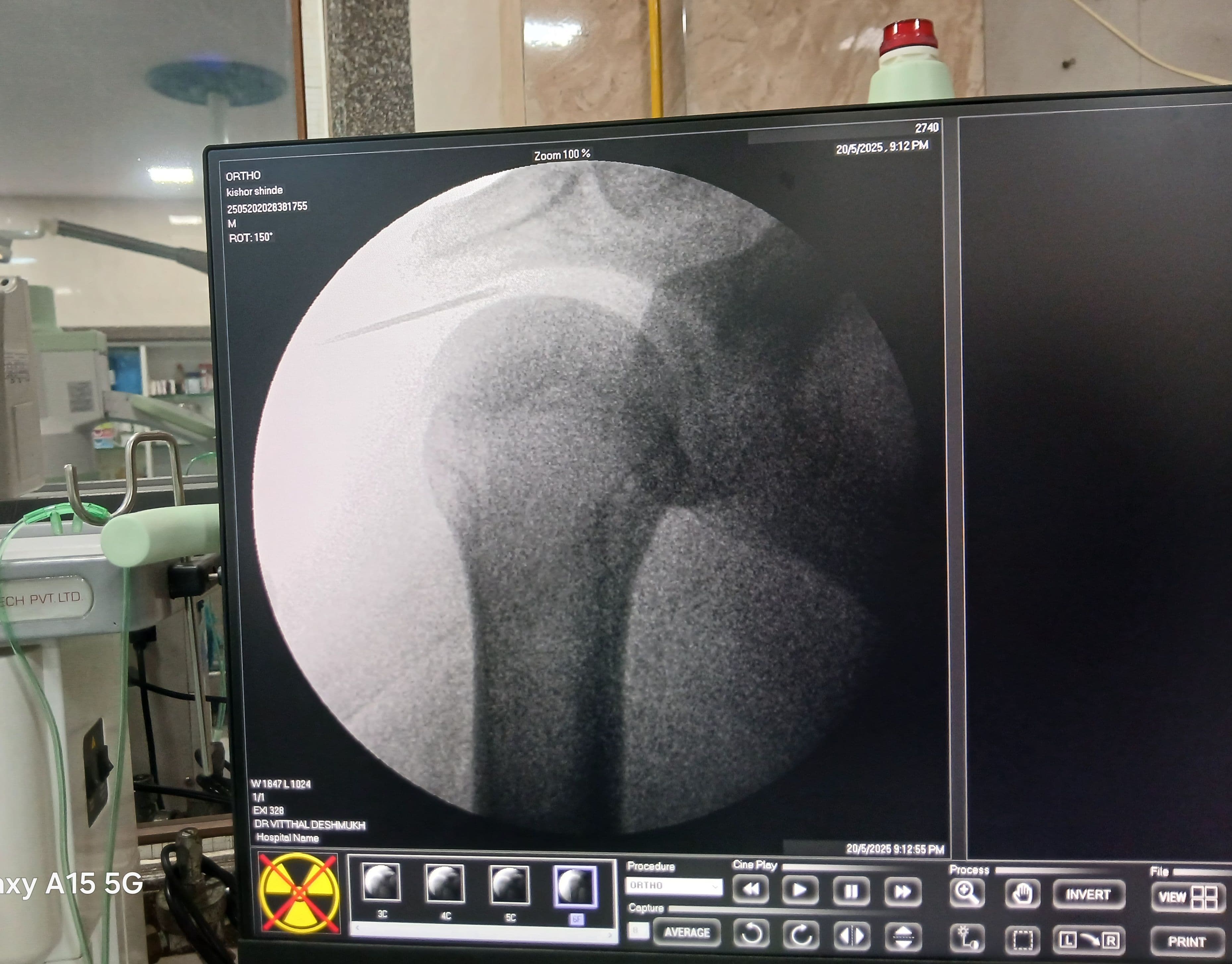 Intra Articular injection under C arm